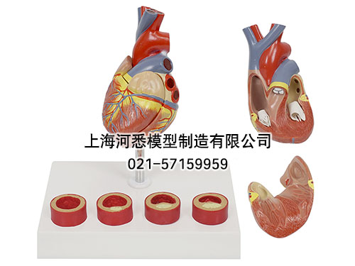 动脉粥硬化带血栓模型