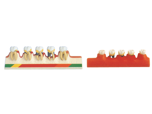 牙周病分类模型